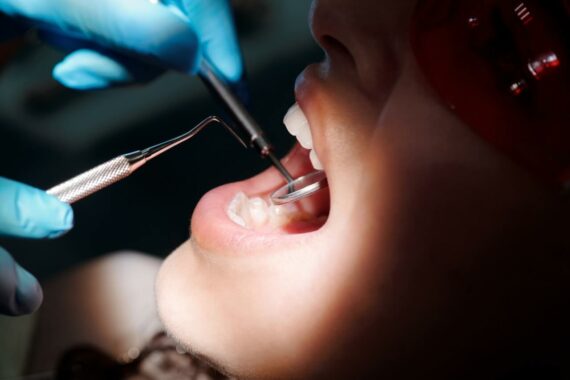 Co to jest koronka dentystyczna?
